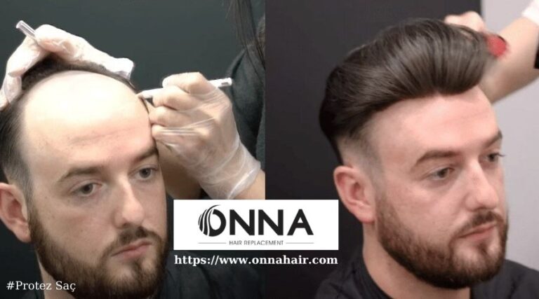 Protez Saç ve Saç Ekimi: Karar Verme Sürecinde Nelere Dikkat Edilmeli?